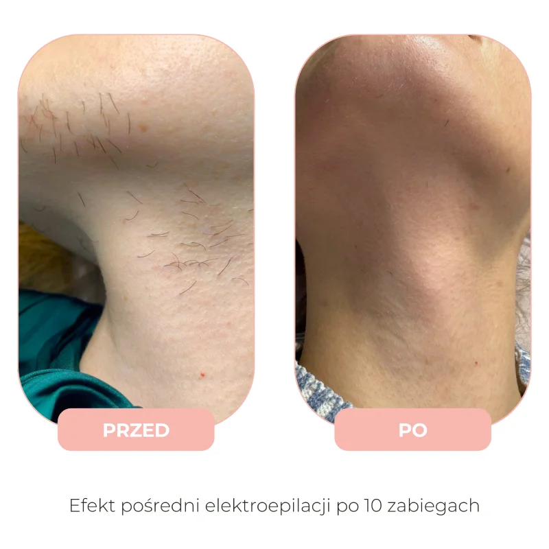 Efekty elektroepilacji przed i po