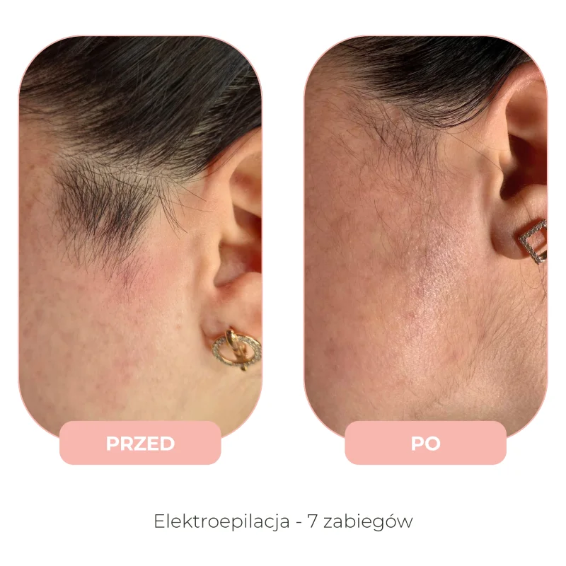 Efekty elektroepilacji przed i po