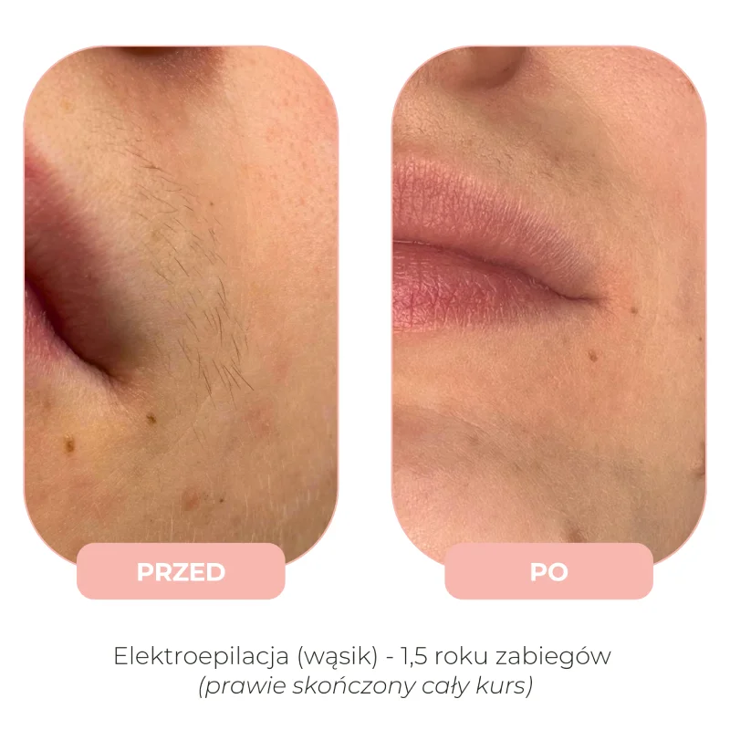 Efekty elektroepilacji przed i po