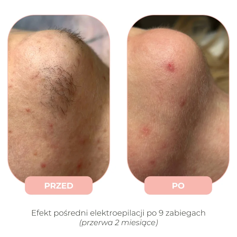 Efekty elektroepilacji przed i po