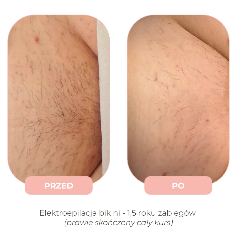Efekty elektroepilacji przed i po