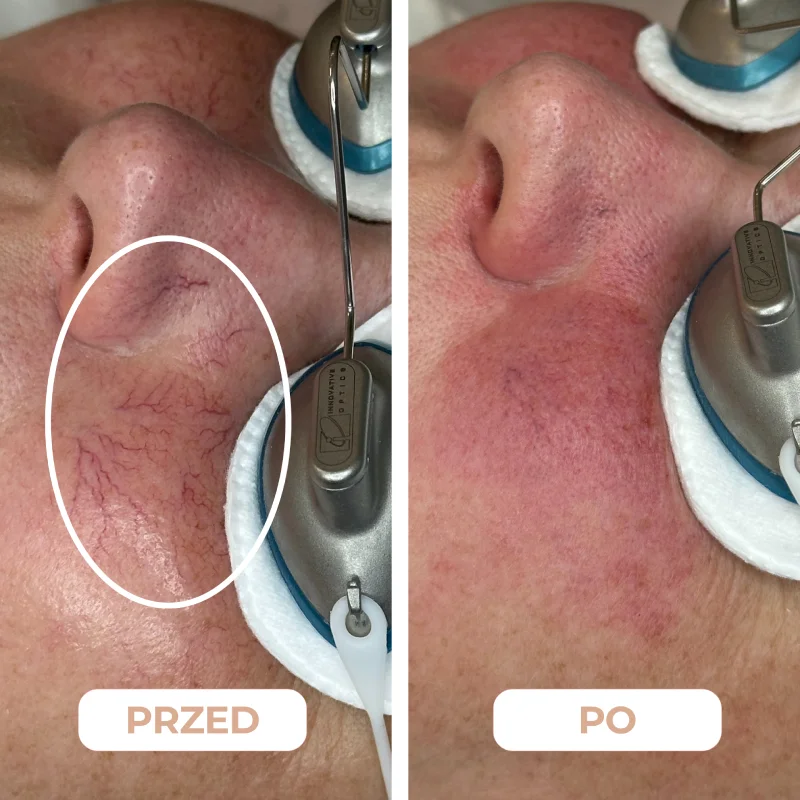 Usuwanie naczynek przed i po zabiegu