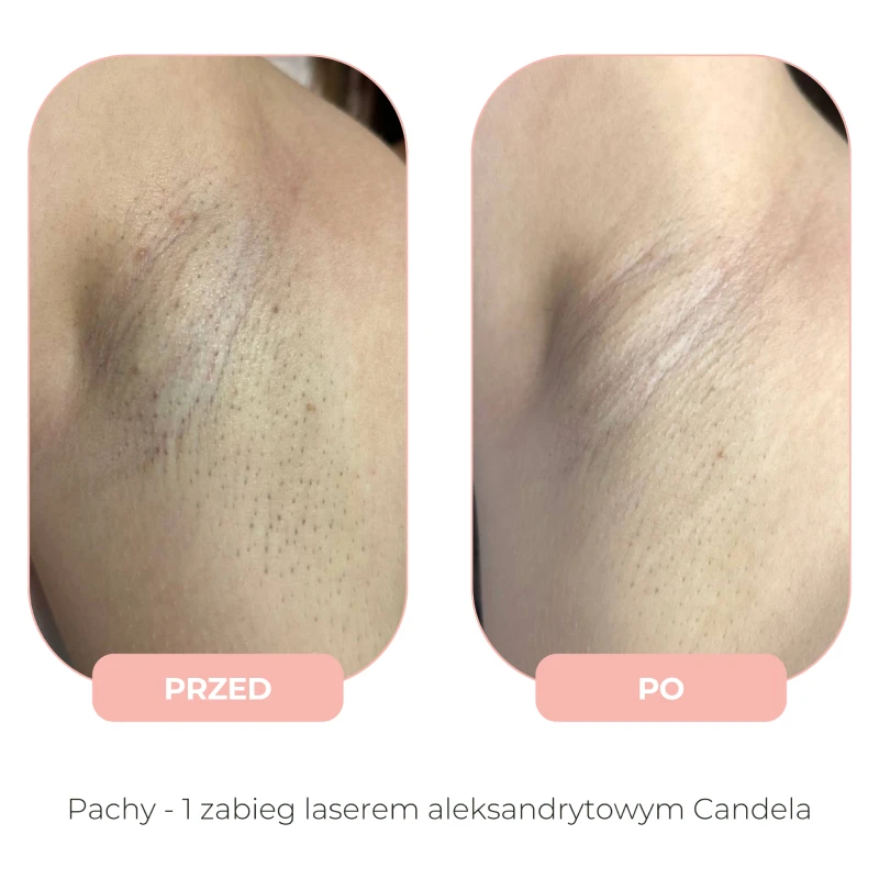 Efekty depilacji laserowej Candela przed i po