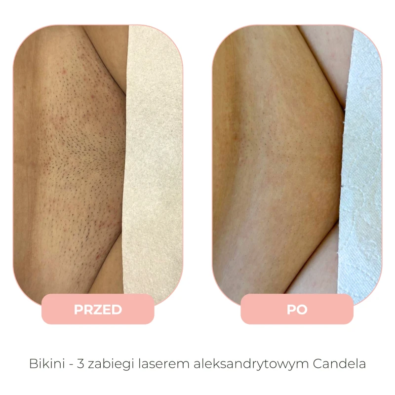 Efekty depilacji laserowej Candela przed i po