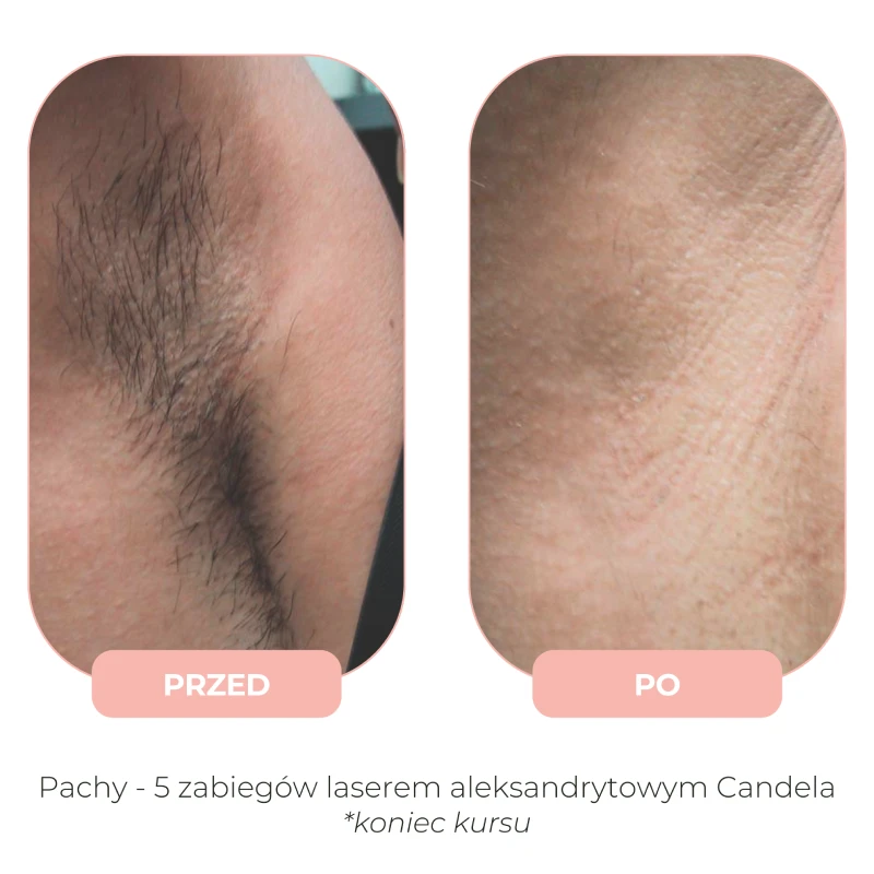 Efekty depilacji laserowej Candela przed i po