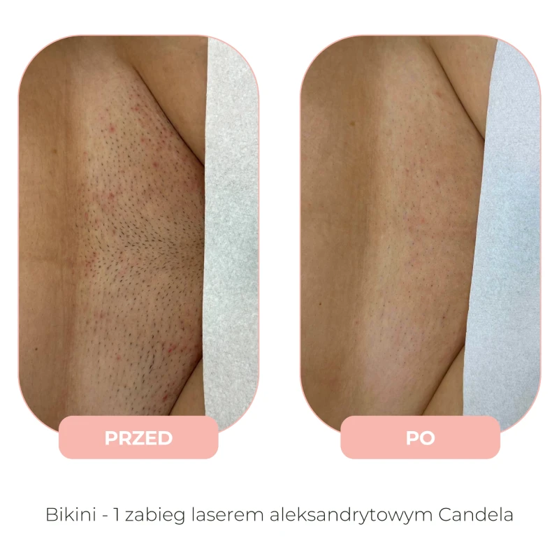Efekty depilacji laserowej Candela przed i po
