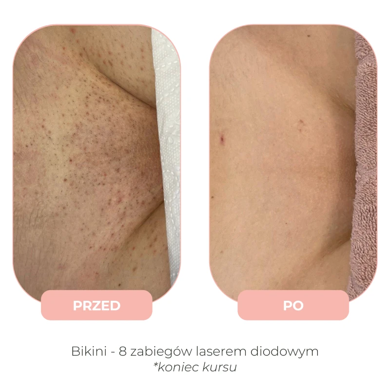 Efekty depilacji laserowej Lumenis przed i po