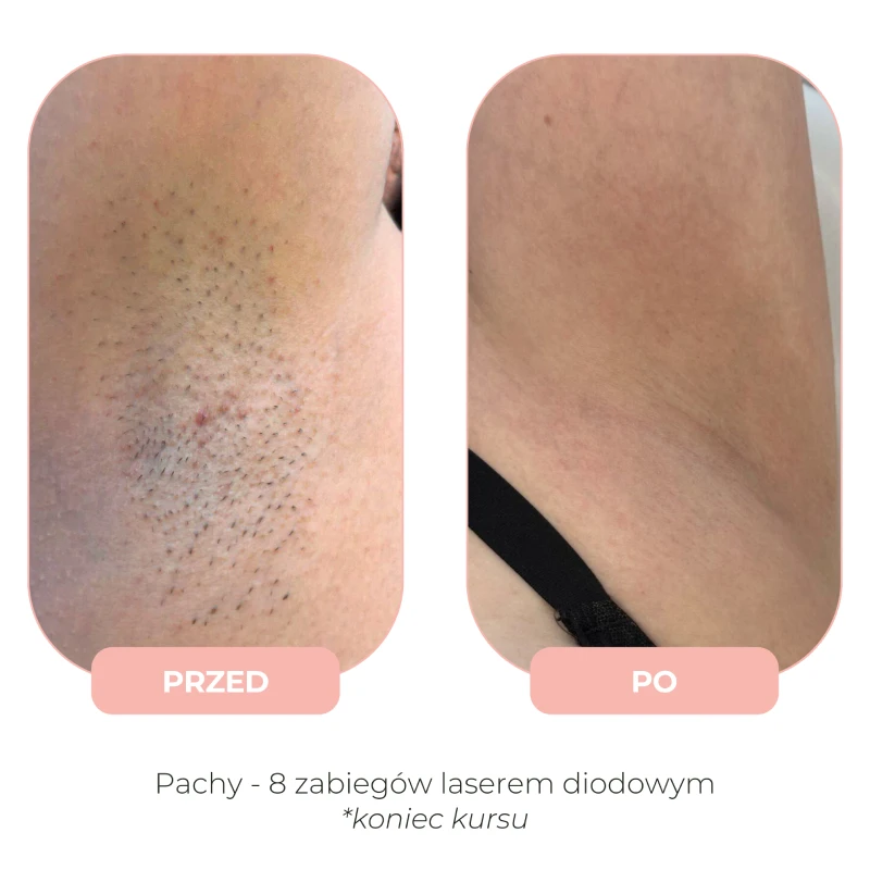 Efekty depilacji laserowej Lumenis przed i po
