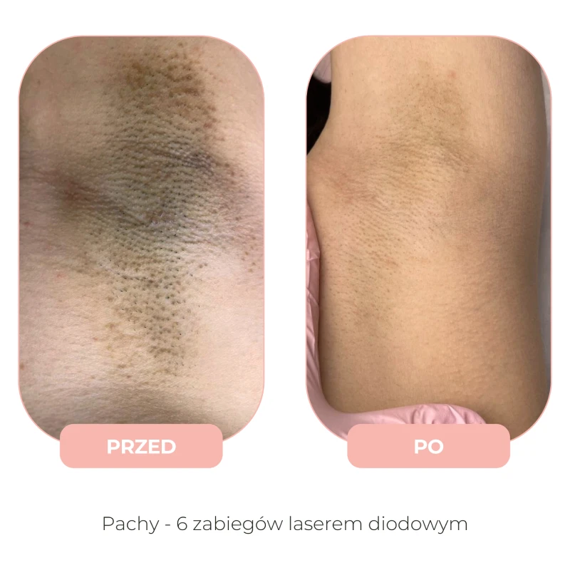 Efekty depilacji laserowej Lumenis przed i po