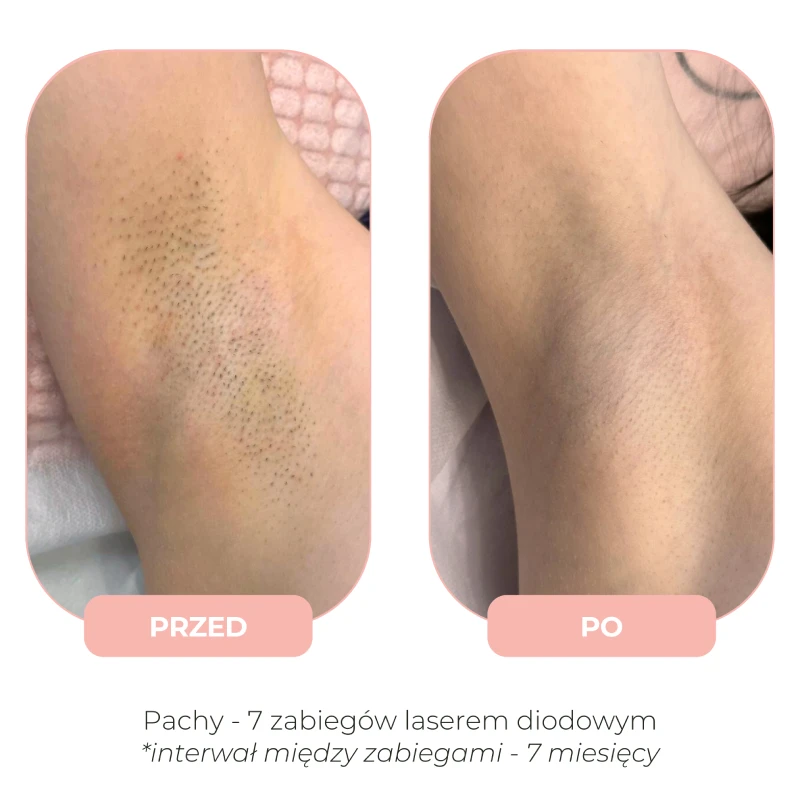 Efekty depilacji laserowej Lumenis przed i po